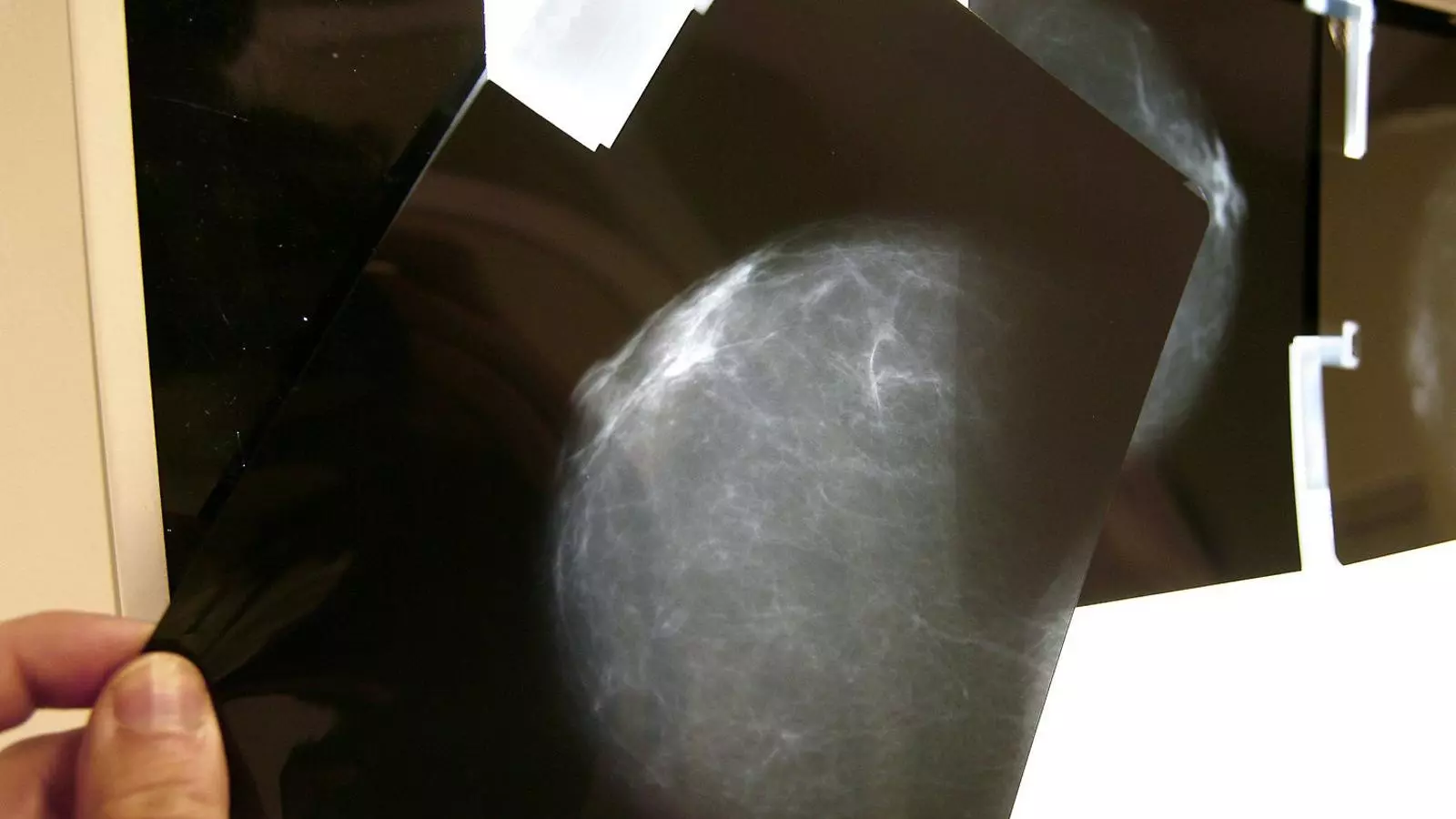 Resultat d’una prova radiològica de mama que permet diagnosticar si es pateix un càncer d’aquest tipus.