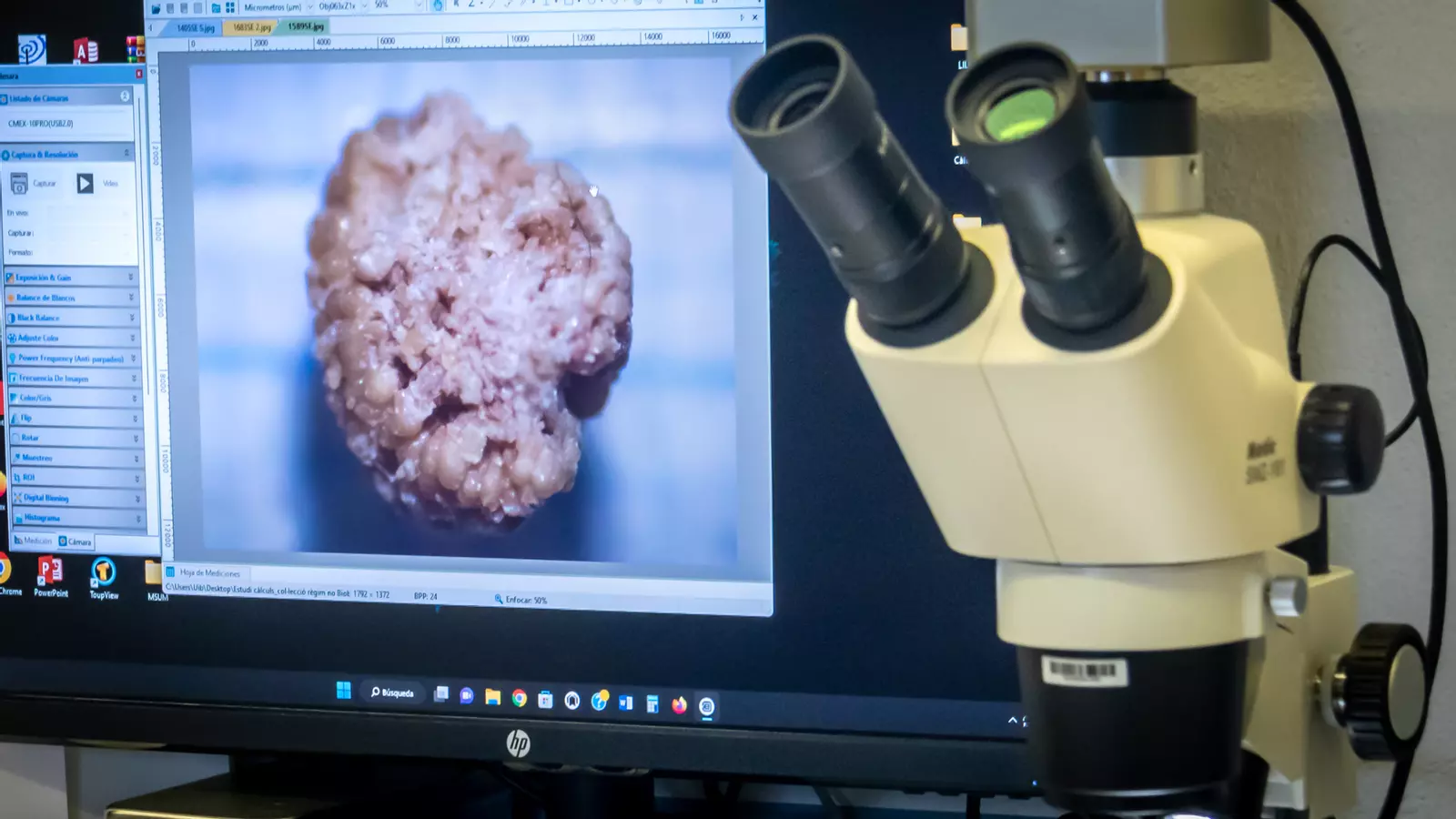 Biobanc de càlculs renals