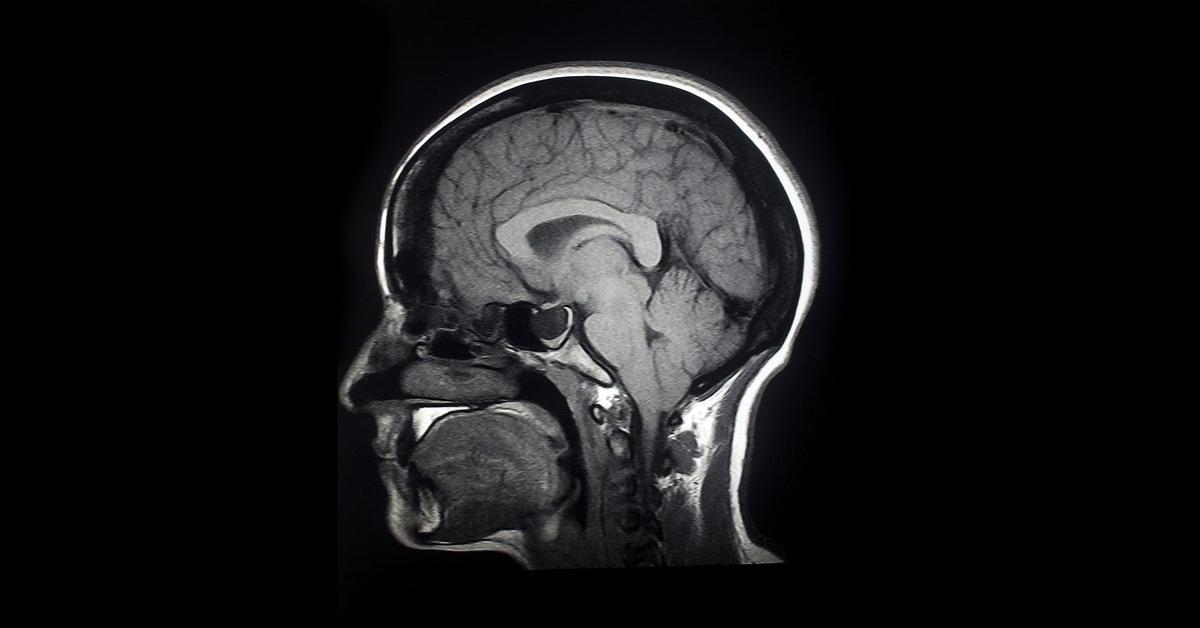 研究は、リチウムでアルツハイマー病を治療するための希望に満ちたギャップを開きます