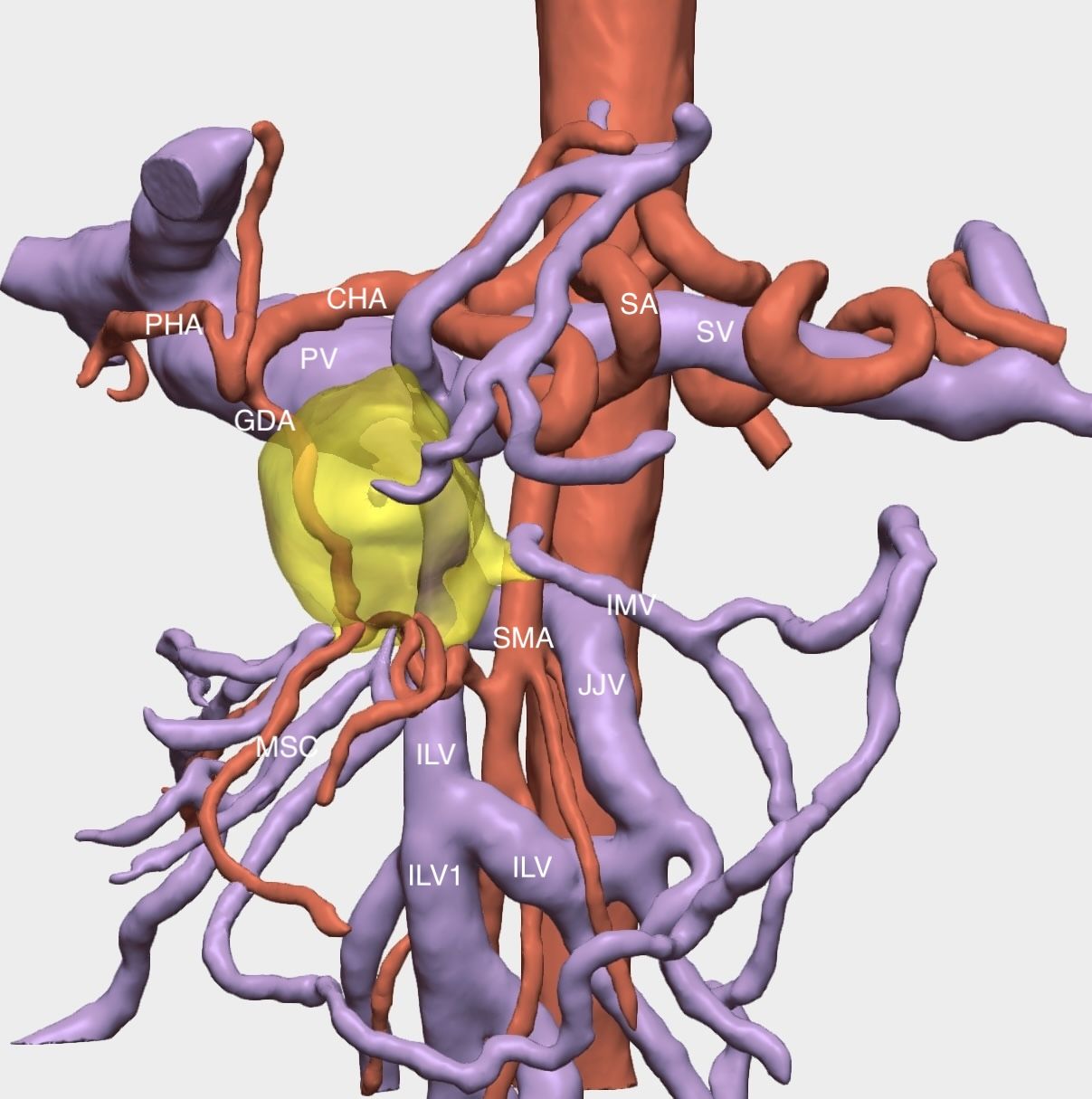 3D model of a tumor