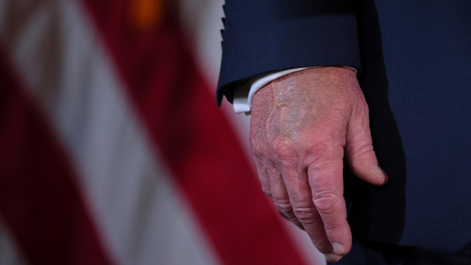 President Donald Trump's swollen hand, in a file photo from last December.