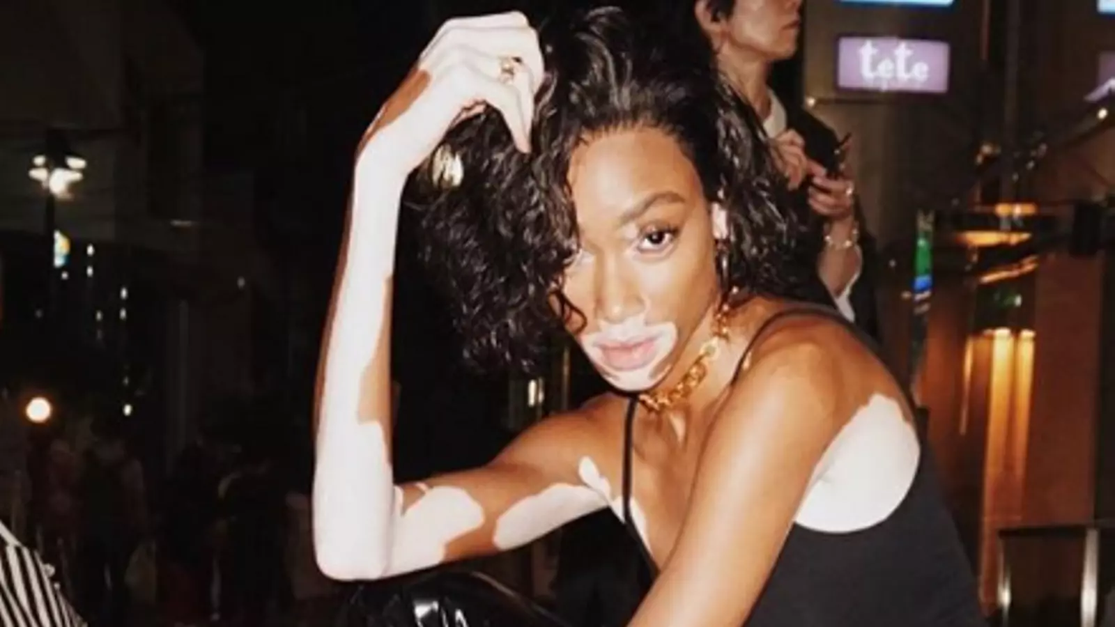 El vitiligo, que pateix Harlow, és una malalatia que provoca taques a la pell.