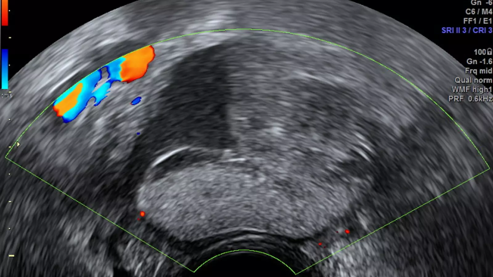 El 70 % dels tumors benignes d'ovari no requereixen cirurgia, segons un estudi de Dexeus