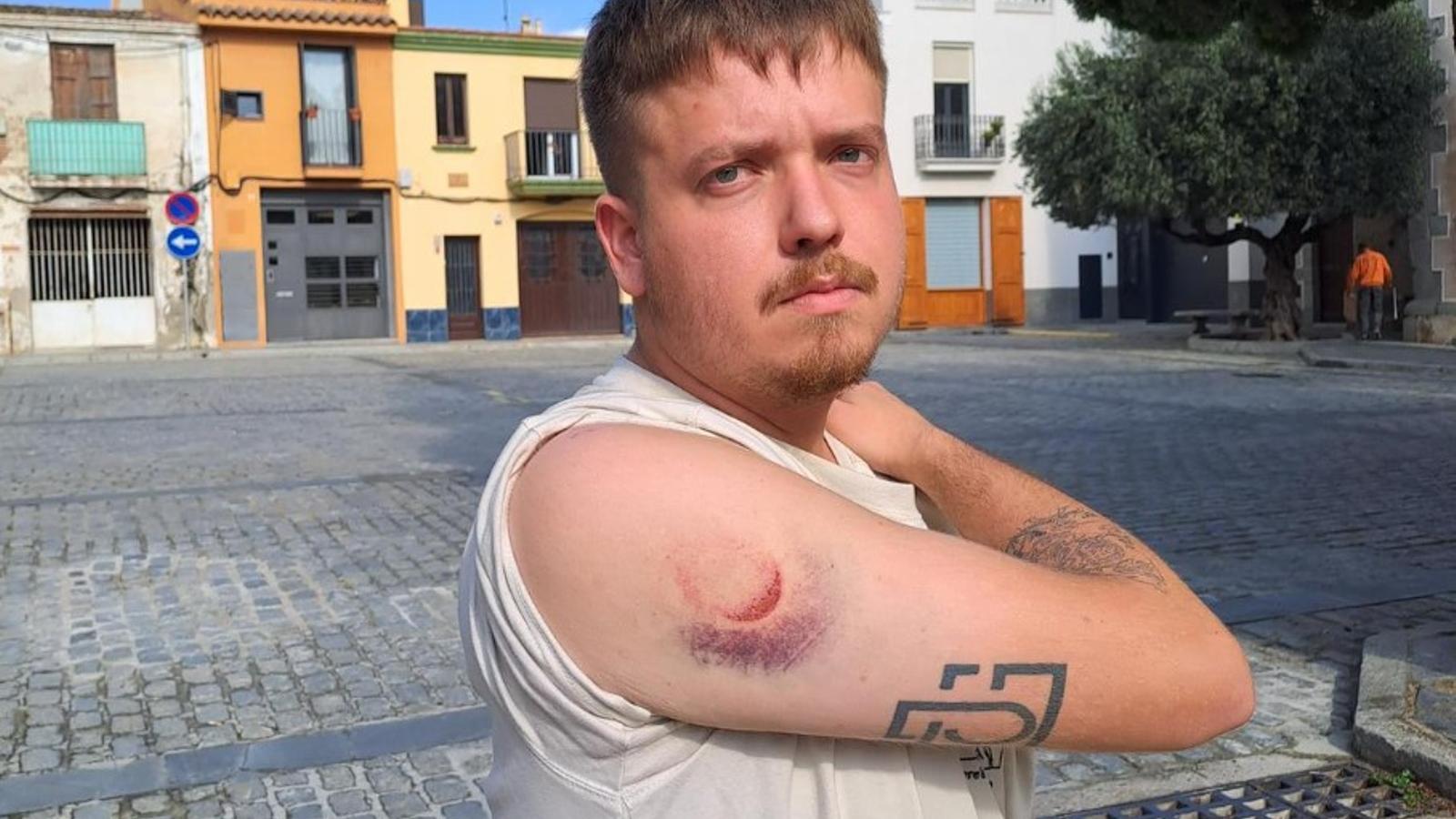 Joan Gálvez shows the wound from a foam bullet impact. The regulations indicate that it is necessary to shoot below the abdomen.