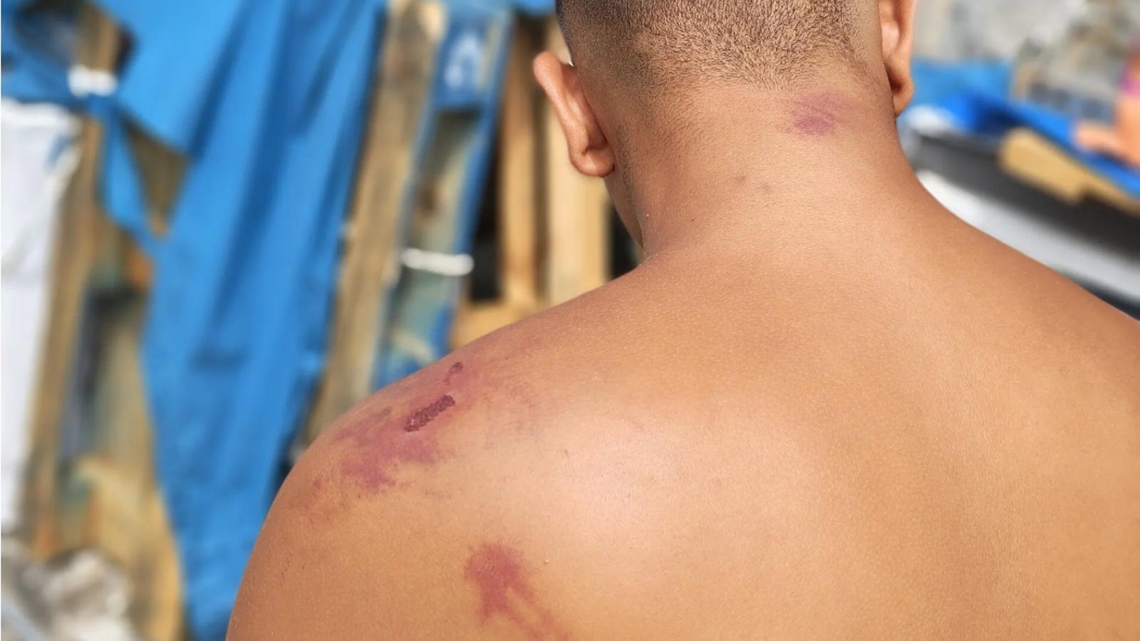 One of the images disseminated by Amnesty International in which the beaten body of a migrant person is seen.