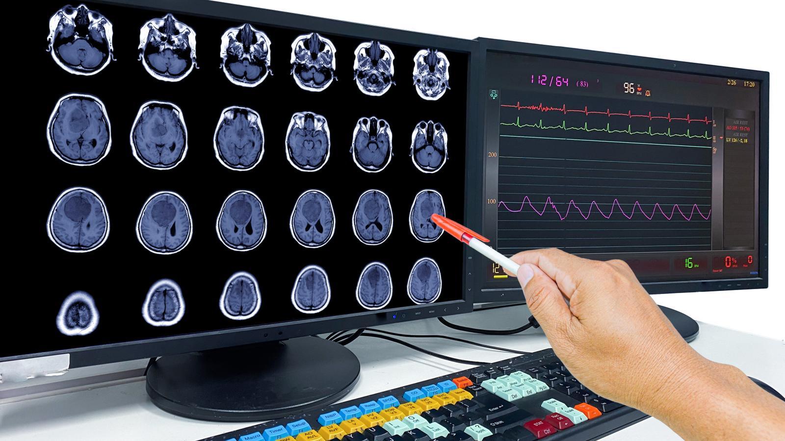 The doctor points to the screen at the location of a brain tumor on an MRI.
