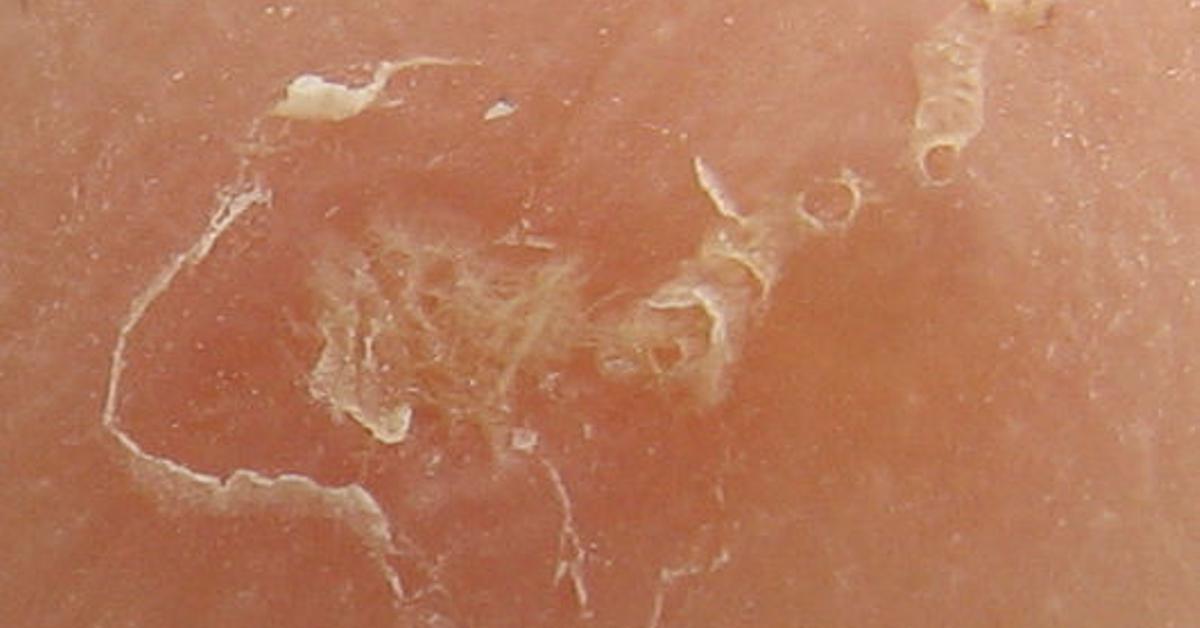 Mil residents de centres geriàtrics s'encomanen de sarna en un any