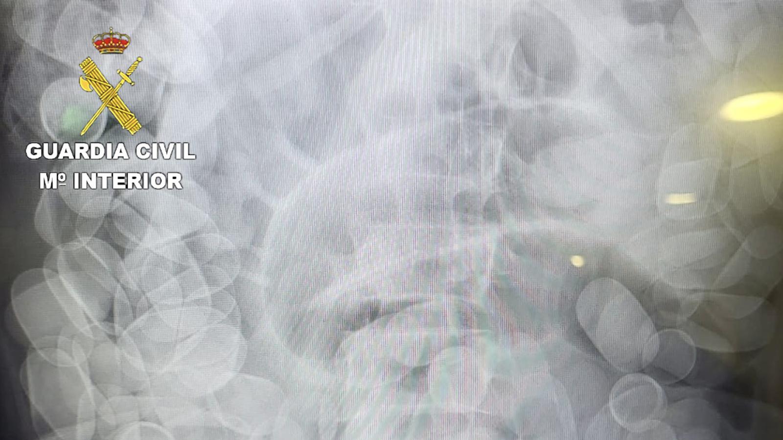 Radiografia on s'observen paquets de cocaïna ingerits
