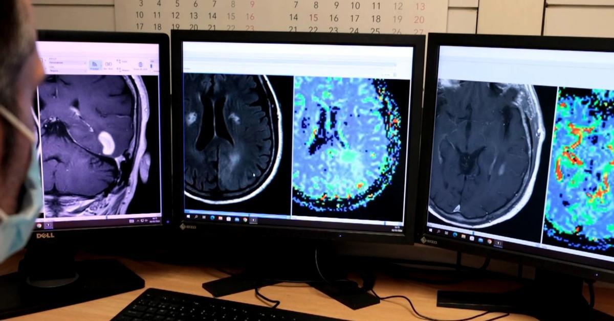 3 種類の脳腫瘍を区別できる AI を開発