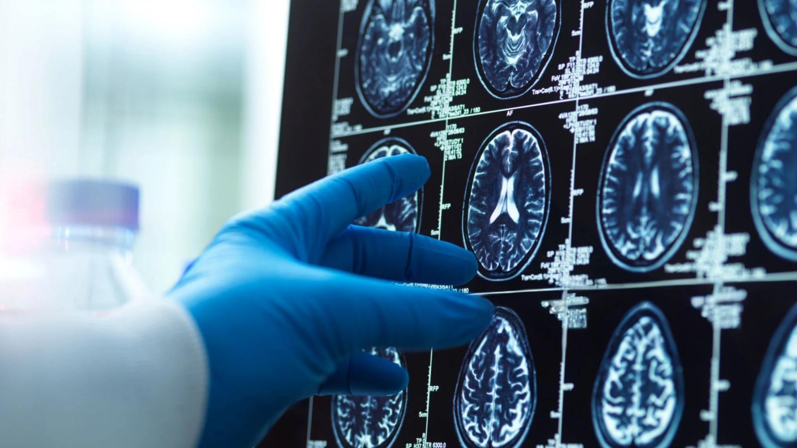 A doctor reviewing a brain scan