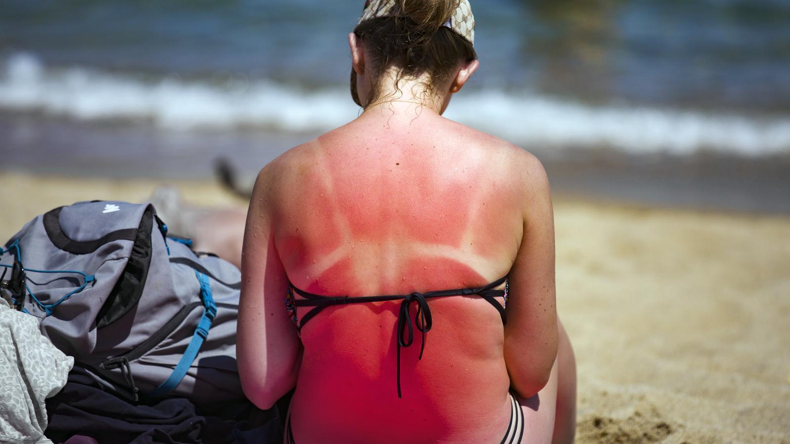 A woman with sunburned skin